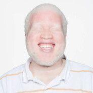 Albino0000